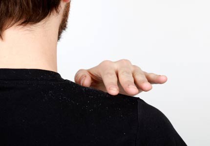 dandruff treatment dandruff remedies